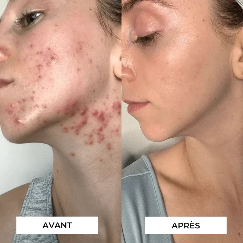 PerfectSkin Wand™ - Dispositif de traitement de l'acnée à haute fréquence